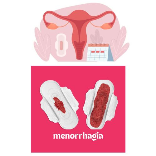 Menorrhagia