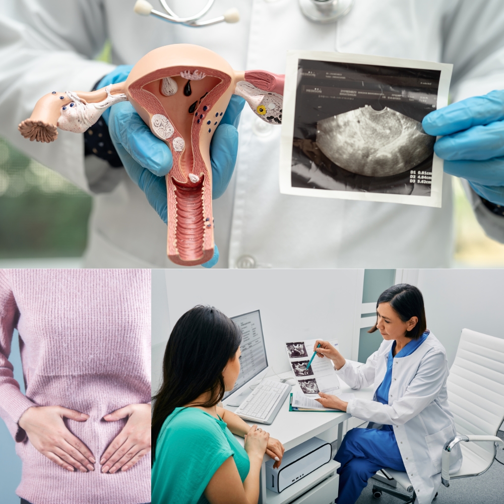 Medical illustration of bulky ovaries with symptoms of PCOS showing enlarged ovaries and hormonal imbalance indicators – bulky ovary symptoms