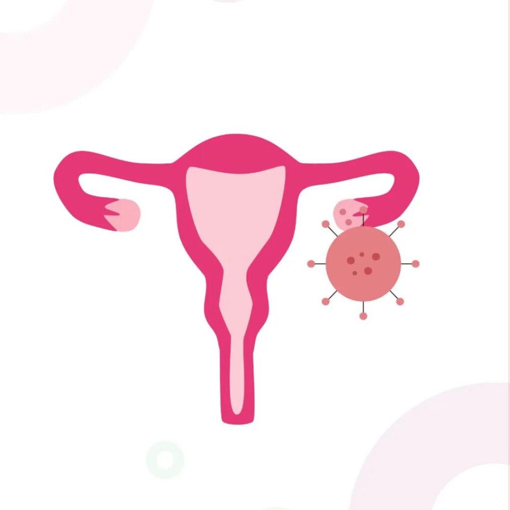 Understanding Premature Ovarian Failure and Its Solutions