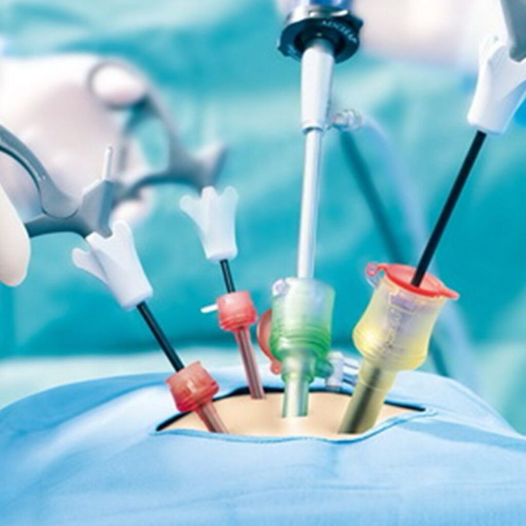 Laparoscopic Surgery for Infertility: A Quick Guide