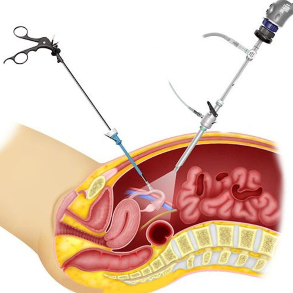 What to Know About Hysteroscopy for Infertility