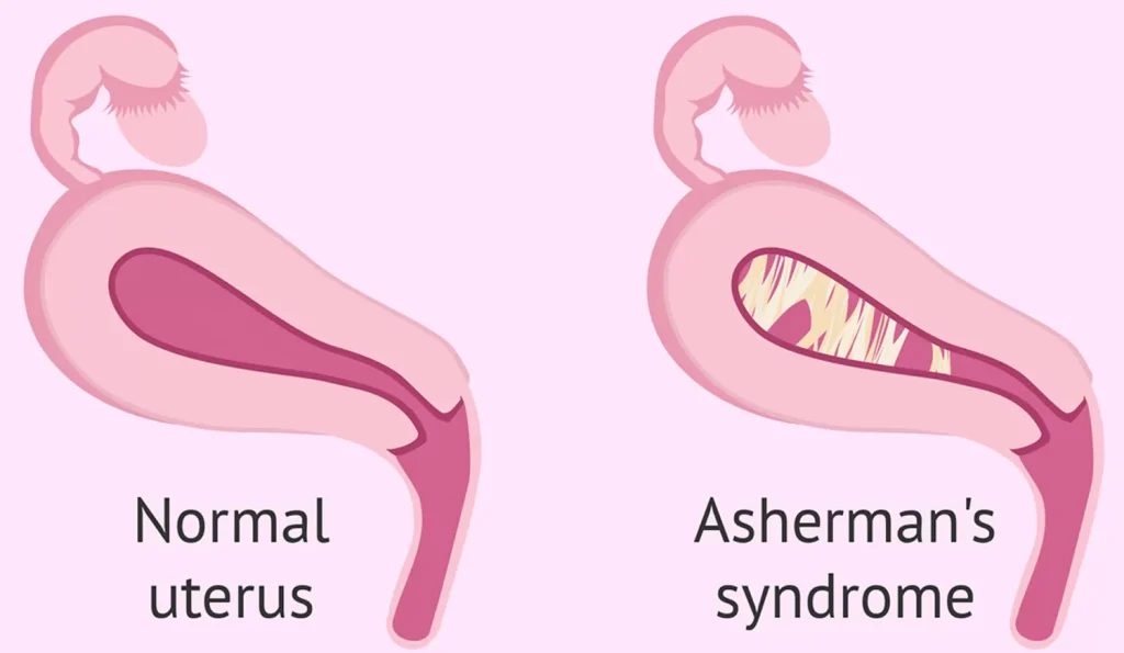 Impact of Asherman’s Syndrome on Fertility